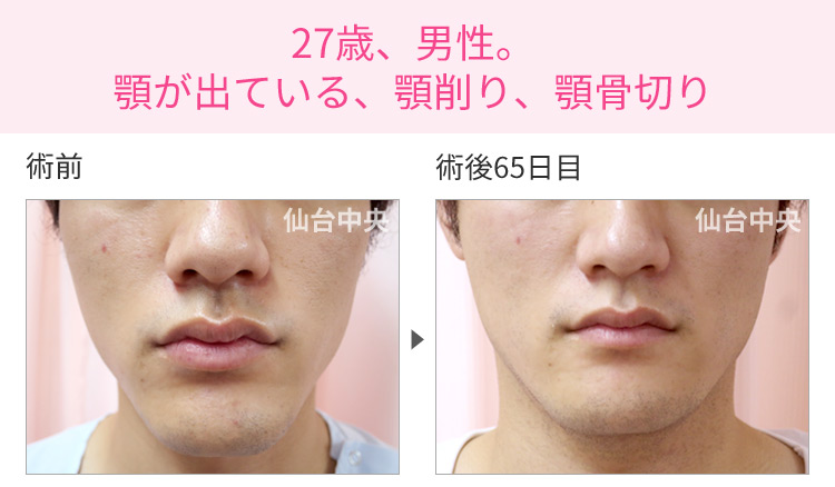 27歳、男性。顎が出ている、顎削り、顎骨切り 症例写真1