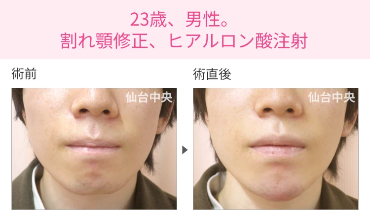 23歳、男性。割れ顎修正、ヒアルロン酸注射 症例写真1