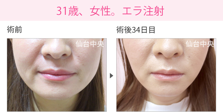 31歳、女性。エラ注射 症例写真1
