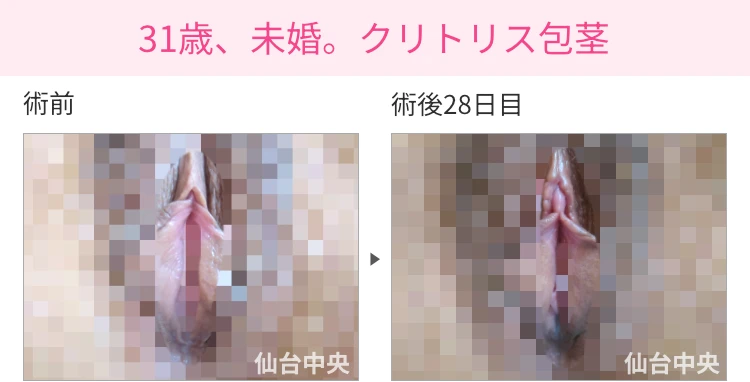 31歳、未婚。クリトリス包茎 症例写真1