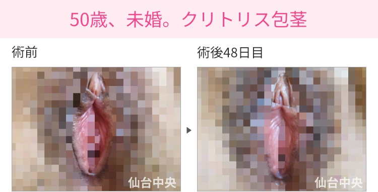 50歳、未婚。クリトリス包茎 症例写真1