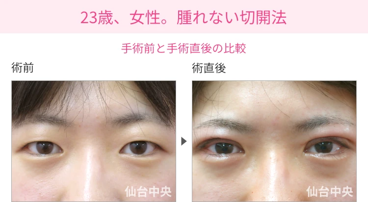 23歳、女性。腫れない切開法。手術前と手術直後の比較 症例写真1
