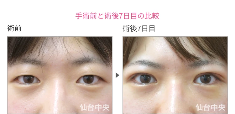 23歳、女性。腫れない切開法。手術前と術後7日目の比較 症例写真4