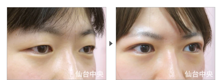 23歳、女性。腫れない切開法。手術前と術後7日目の比較 症例写真5