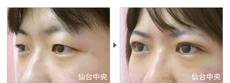 23歳、女性。腫れない切開法。手術前と術後7日目の比較 症例写真6