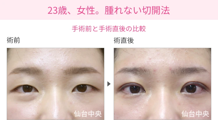23歳、女性。腫れない切開法。手術前と手術直後の比較 症例写真1