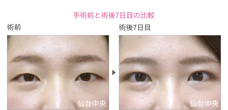 23歳、女性。腫れない切開法。手術前と術後7日目の比較 症例写真4
