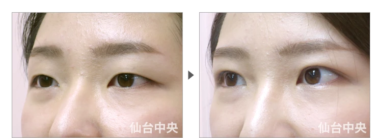 23歳、女性。腫れない切開法。手術前と術後7日目の比較 症例写真6