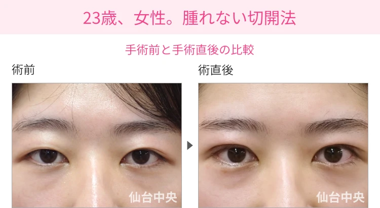 23歳、女性。腫れない切開法。手術前と手術直後の比較 症例写真1