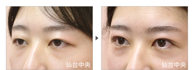 23歳、女性。腫れない切開法。手術前と手術直後の比較 症例写真3