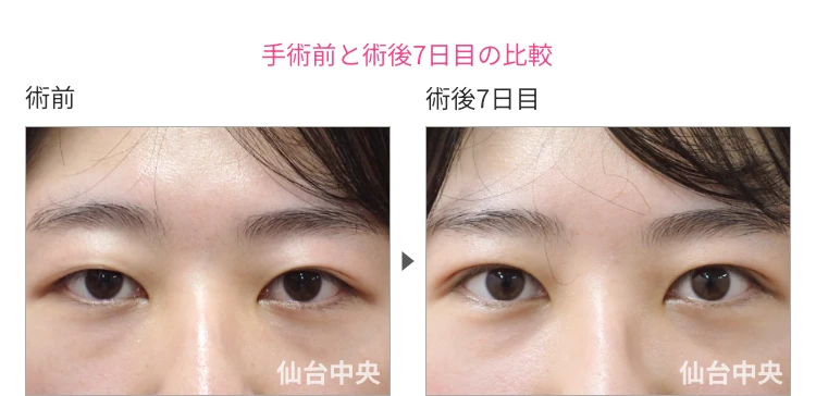 23歳、女性。腫れない切開法。手術前と術後7日目の比較 症例写真4