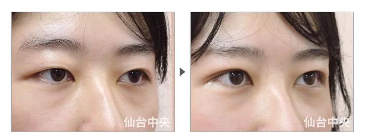 23歳、女性。腫れない切開法。手術前と術後7日目の比較 症例写真5
