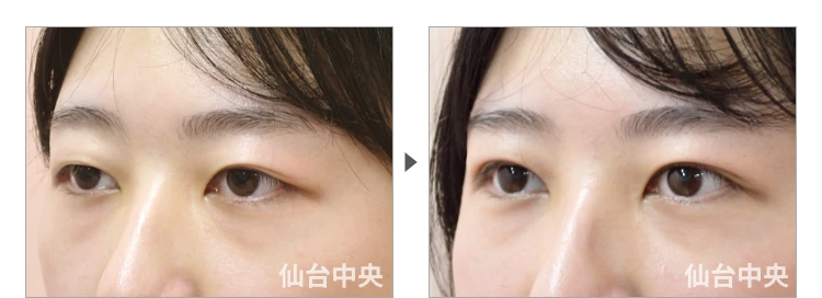 23歳、女性。腫れない切開法。手術前と術後7日目の比較 症例写真6