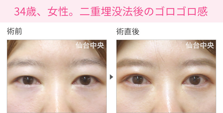 他院による埋没法後の違和感への対処手術症例写真。術前と術直後（30代女性） - 仙台中央クリニック 症例写真1