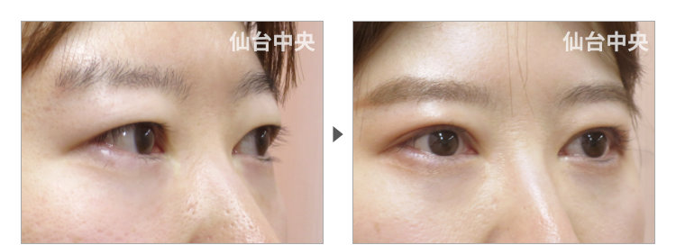 他院による埋没法後の違和感への対処手術症例写真。術前と術直後（30代女性） - 仙台中央クリニック 症例写真2