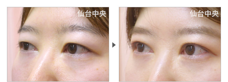 他院による埋没法後の違和感への対処手術症例写真。術前と術直後（30代女性） - 仙台中央クリニック 症例写真3