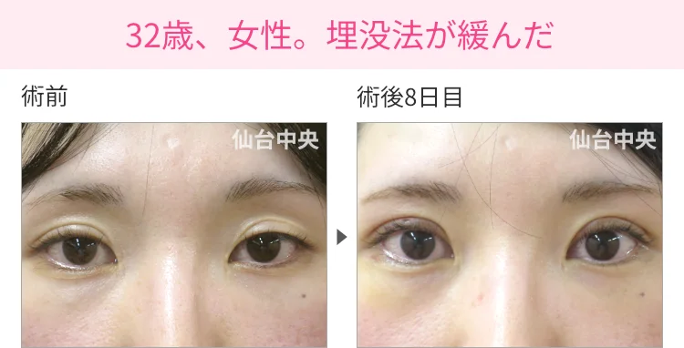 32歳、女性。埋没法が緩んだ症例写真 症例写真1