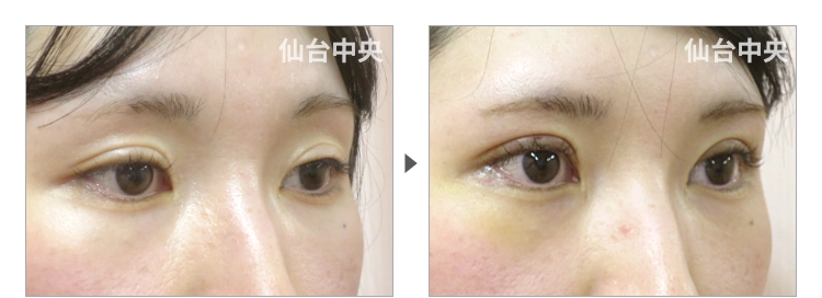 32歳、女性。埋没法が緩んだ症例写真 症例写真2