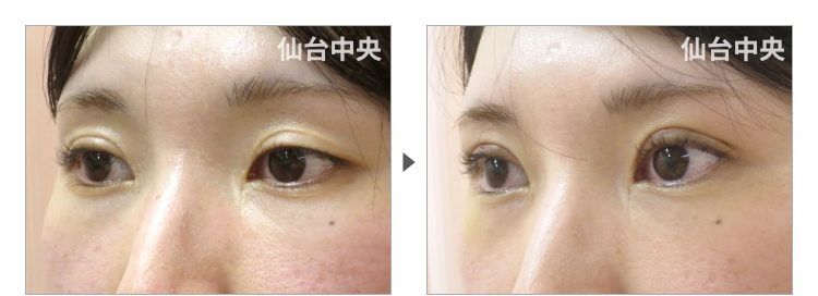 32歳、女性。埋没法が緩んだ症例写真 症例写真3