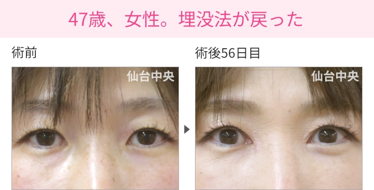 47歳、女性。埋没法が戻った症例写真 症例写真1