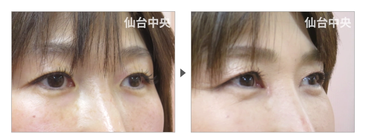 47歳、女性。埋没法が戻った症例写真 症例写真2