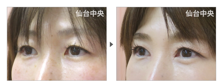 47歳、女性。埋没法が戻った症例写真 症例写真3