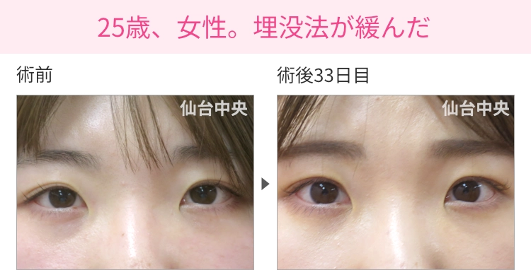 25歳、女性。埋没法が緩んだ症例写真 症例写真1