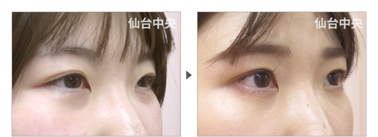 25歳、女性。埋没法が緩んだ症例写真 症例写真2
