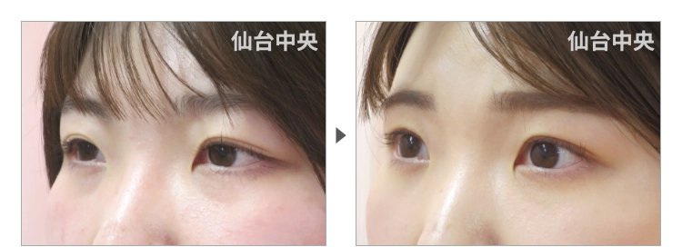 25歳、女性。埋没法が緩んだ症例写真 症例写真3