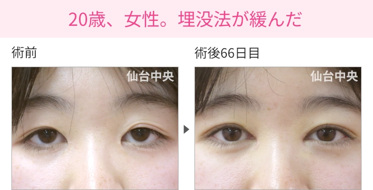 20歳、女性。埋没法が緩んだ 症例写真1