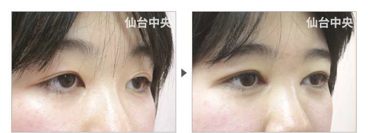 20歳、女性。埋没法が緩んだ 症例写真2
