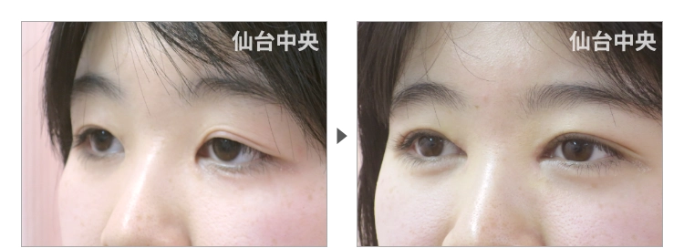 20歳、女性。埋没法が緩んだ 症例写真3