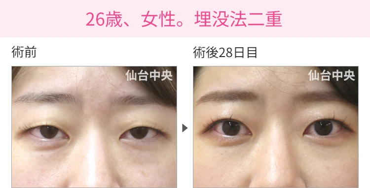 26歳、女性。埋没法二重 症例写真 症例写真1