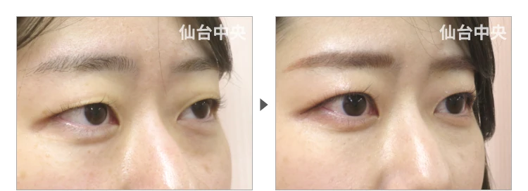 26歳、女性。埋没法二重 症例写真 症例写真2