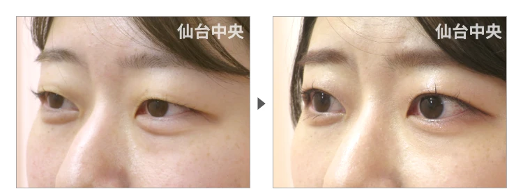 26歳、女性。埋没法二重 症例写真 症例写真3