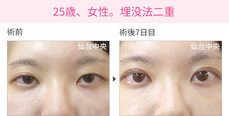 25歳、女性。埋没法二重 症例写真 症例写真1