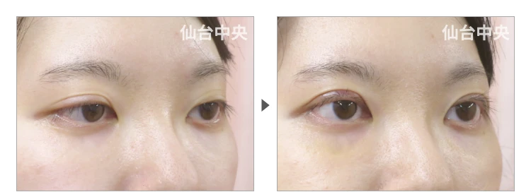 25歳、女性。埋没法二重 症例写真 症例写真2