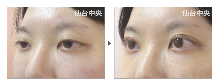 25歳、女性。埋没法二重 症例写真 症例写真3