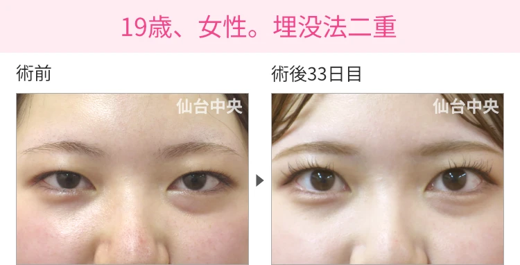 19歳、女性。埋没法二重 症例写真 症例写真1