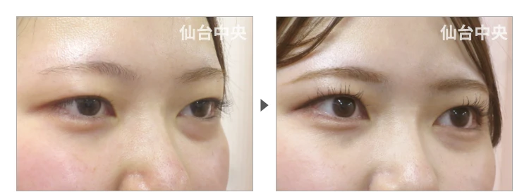 19歳、女性。埋没法二重 症例写真 症例写真2