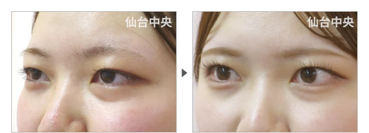19歳、女性。埋没法二重 症例写真 症例写真3