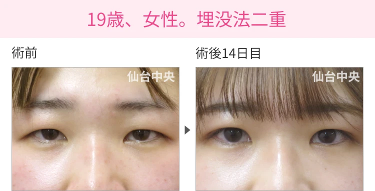 19歳、女性。埋没法二重 症例写真 症例写真1