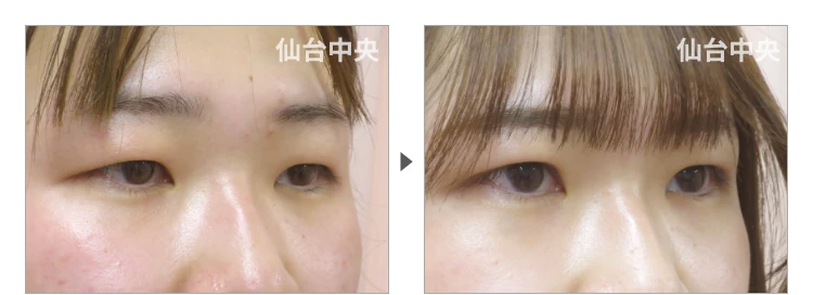 19歳、女性。埋没法二重 症例写真 症例写真2