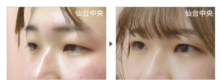 19歳、女性。埋没法二重 症例写真 症例写真3