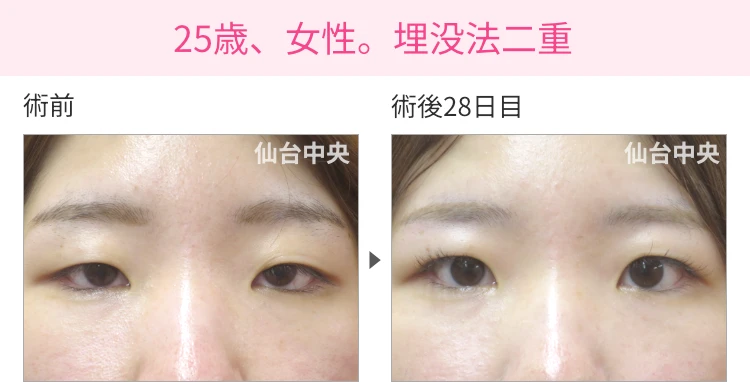 25歳、女性。埋没法二重 症例写真 症例写真1