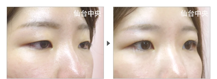 25歳、女性。埋没法二重 症例写真 症例写真2