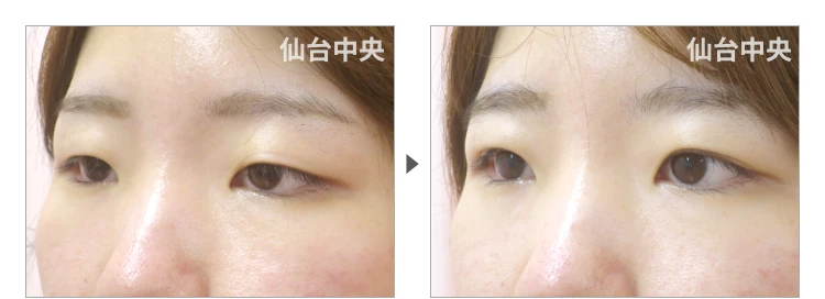 25歳、女性。埋没法二重 症例写真 症例写真3