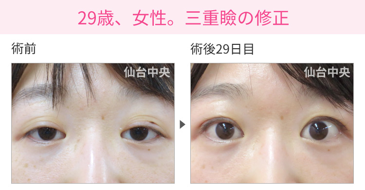 29歳、女性。三重瞼の修正 症例写真1