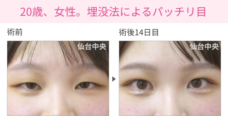 20歳、女性。埋没法によるパッチリ目 症例写真1