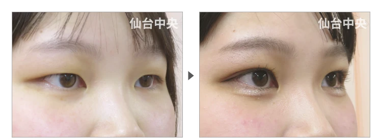 20歳、女性。埋没法によるパッチリ目 症例写真2